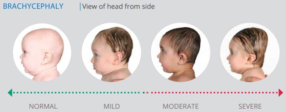 brachycephaly degrees