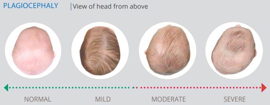 plagiocephaly treatment