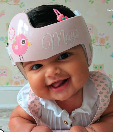 casco para plagiocefalia