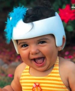 baby with plagiocephaly
