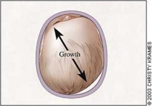 plagiocephaly treatment