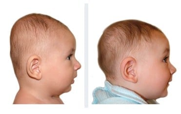 braquicefalia con bebe de 4 meses