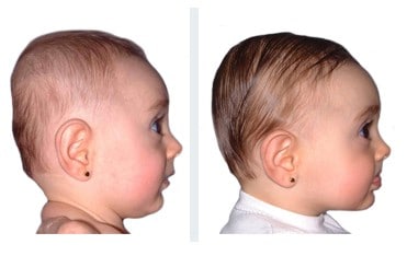 difference between plagiocephaly and brachycephaly