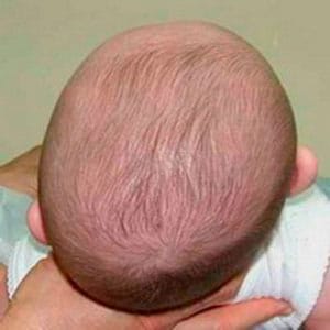 what-is-plagiocephaly
