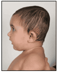 forma del profilo della brachicefalia