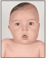 Асимметрия черепа у ребенка