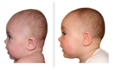 Helmet therapy results before and after treatment