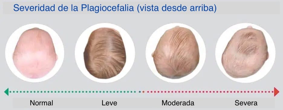 Plagiocefalia: ¿Cómo prevenir y tratar la cada vez más frecuente deformidad  de cabeza de los bebés?