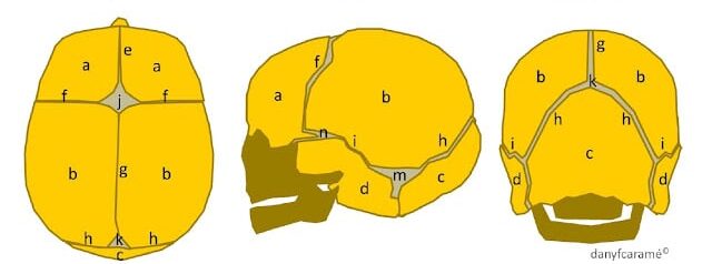 craniosinostose suturas cranianas