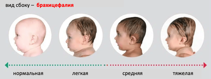 Брахицефалия - лечение и результаты