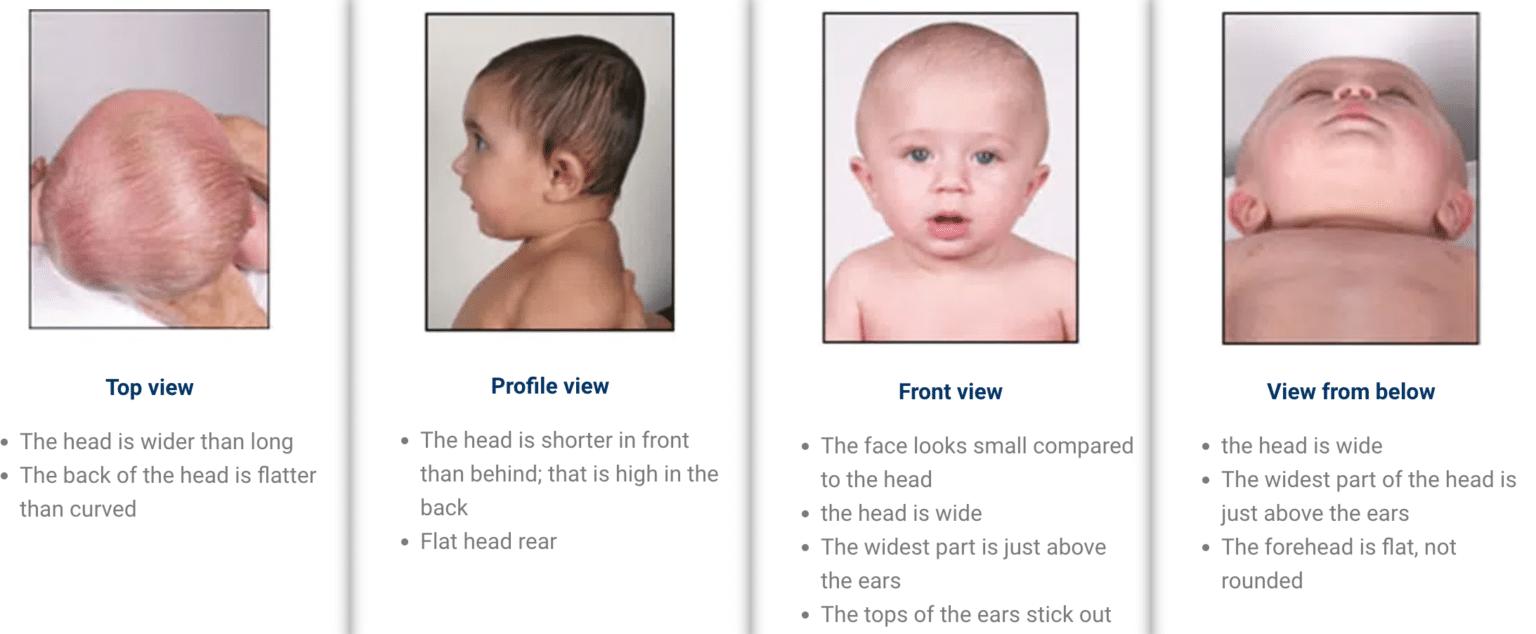 Difference between plagiocephaly and brachycephaly