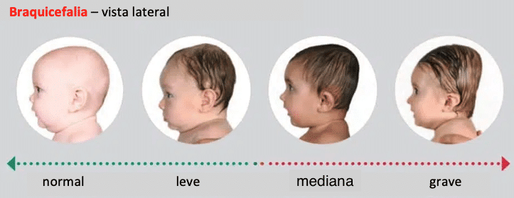 severidade braquicefalia